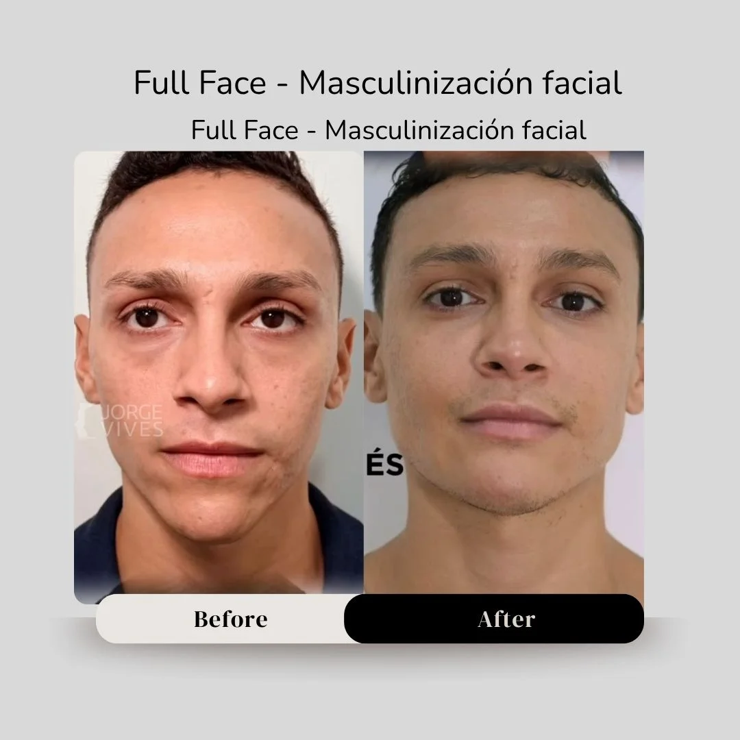 Facial masculinization before and after - Dr. Jorge Vives - Cartagena, Colombia 2
