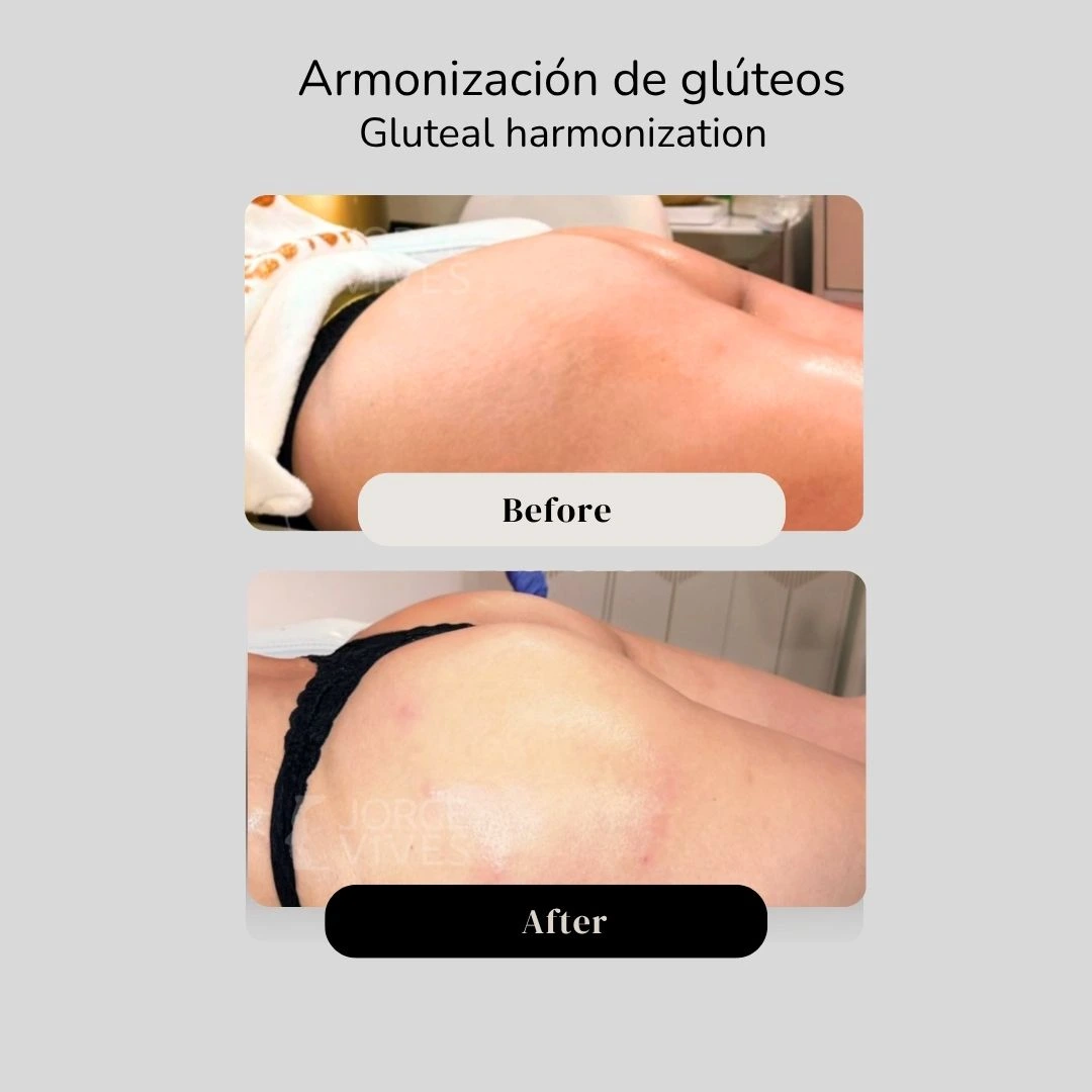 Gluteal harmonization before and after - Dr. Jorge Vives - Cartagena, Colombia 2