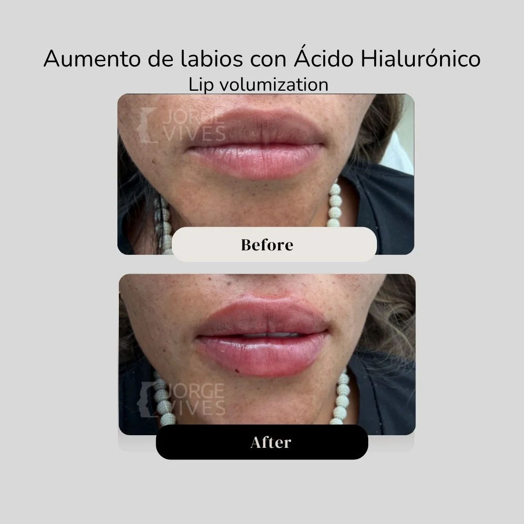 Lip volumization with hyaluronic acid filler before and after - Dr. Jorge Vives - Cartagena, Colombia 1