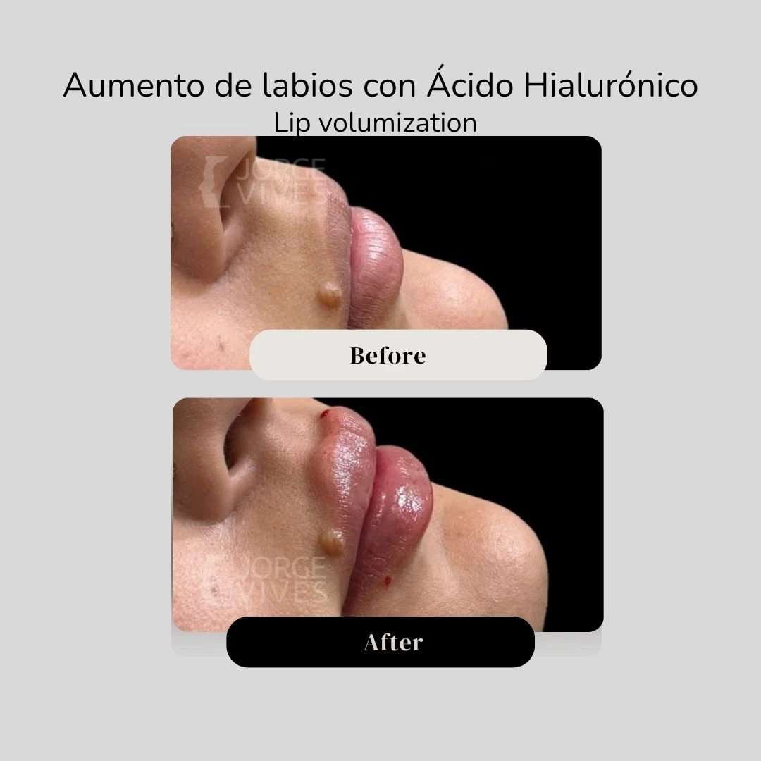 Lip volumization with hyaluronic acid filler before and after - Dr. Jorge Vives - Cartagena, Colombia 10