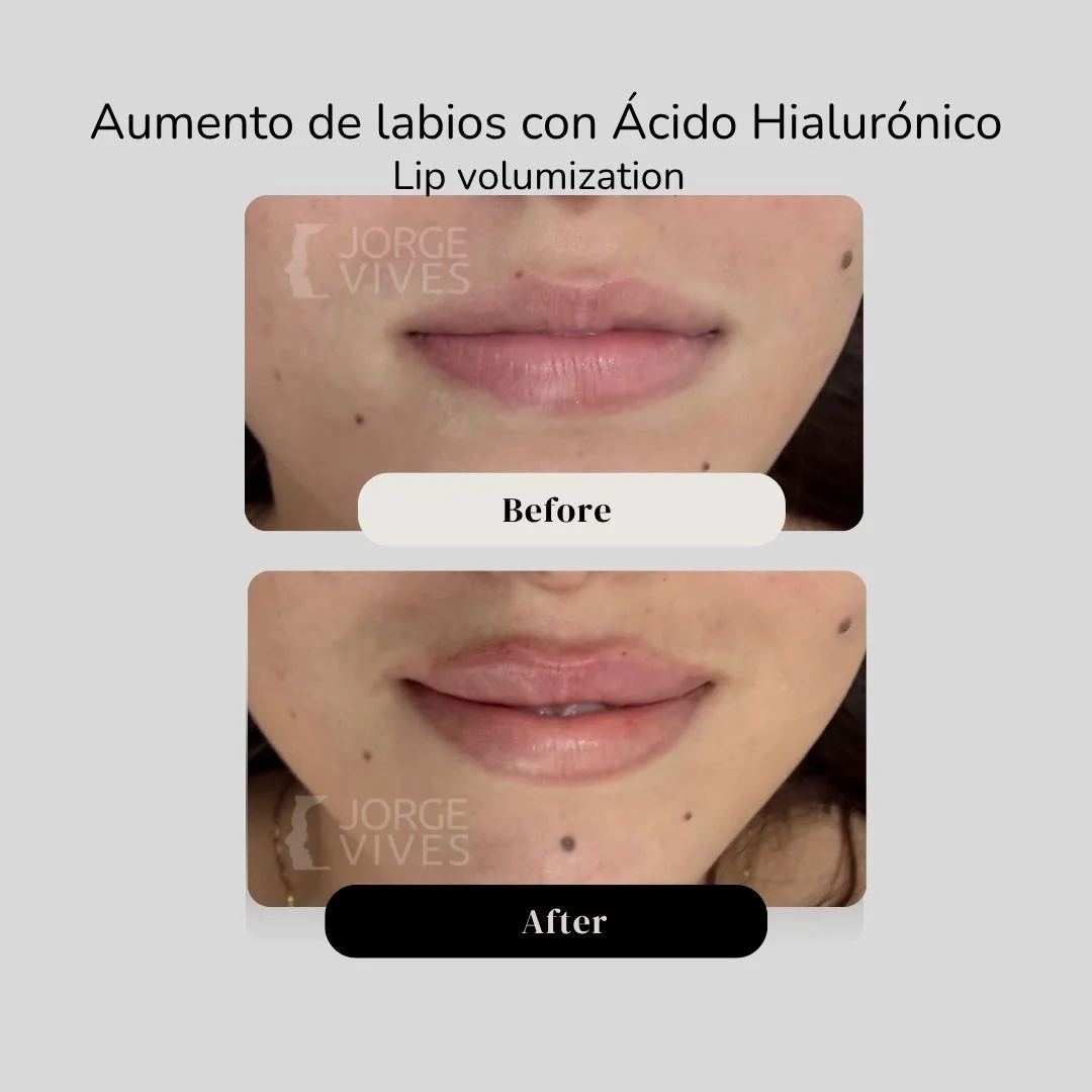 Lip volumization with hyaluronic acid filler before and after - Dr. Jorge Vives - Cartagena, Colombia 2