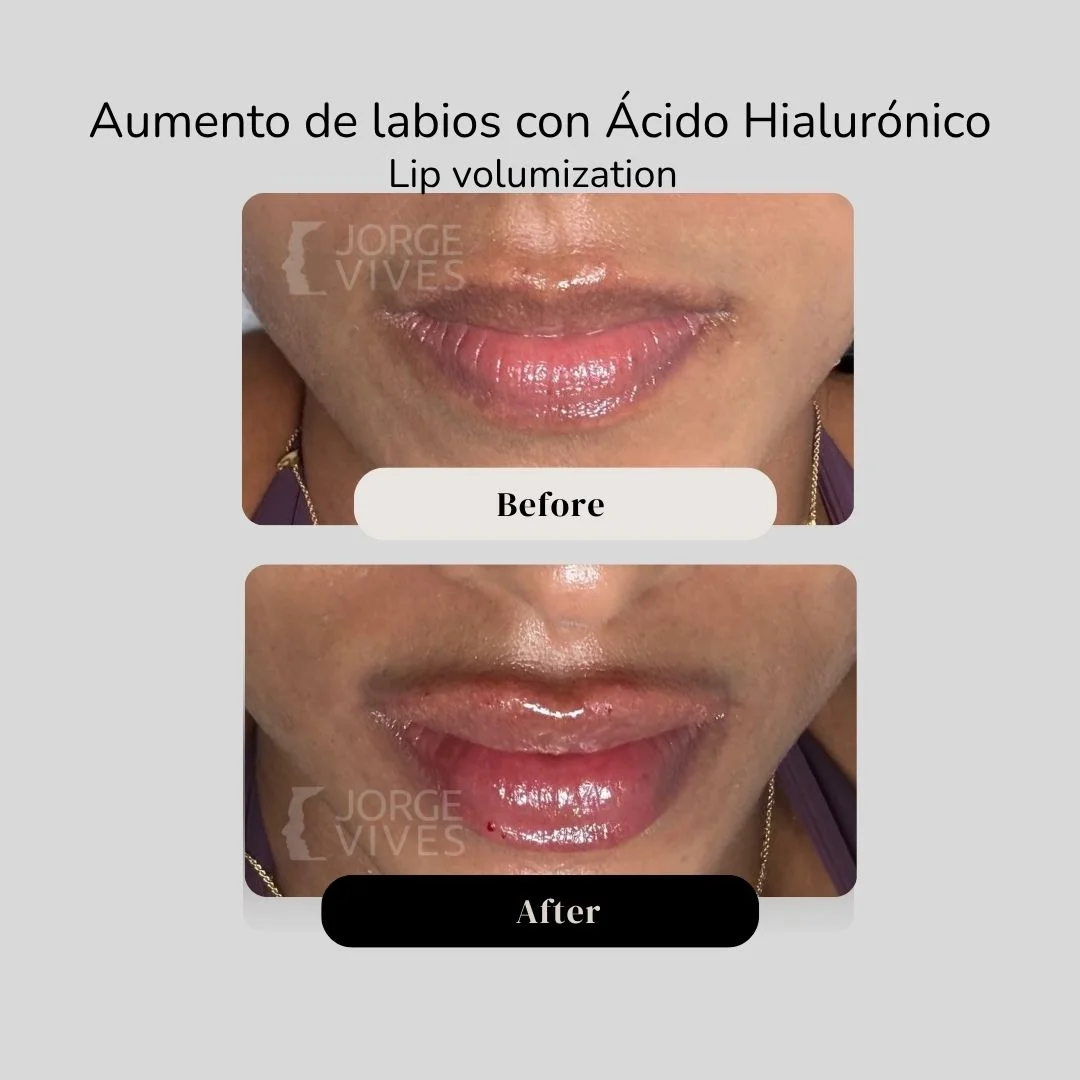 Lip volumization with hyaluronic acid filler before and after - Dr. Jorge Vives - Cartagena, Colombia 3