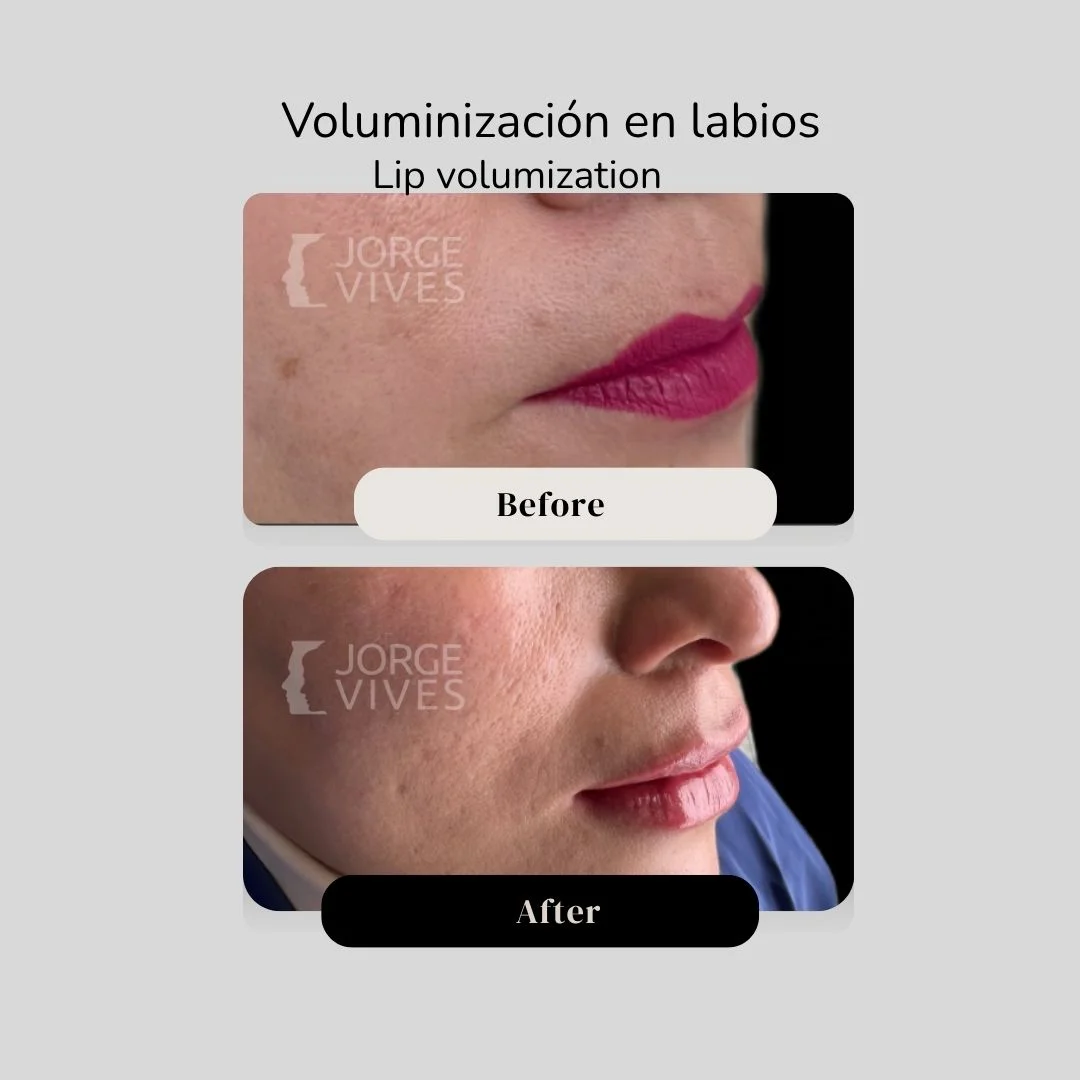 Lip volumization with hyaluronic acid filler before and after - Dr. Jorge Vives - Cartagena, Colombia 5