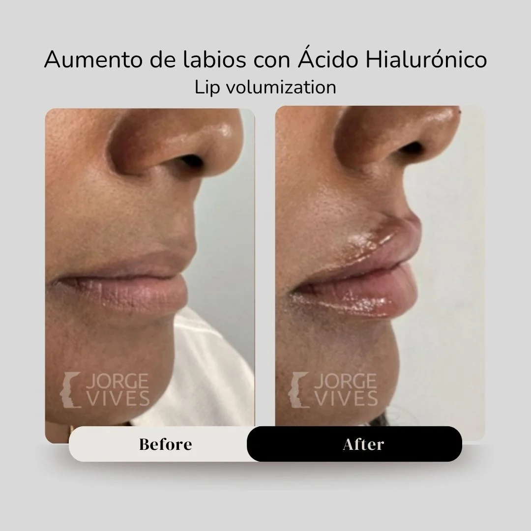 Lip volumization with hyaluronic acid filler before and after - Dr. Jorge Vives - Cartagena, Colombia 6