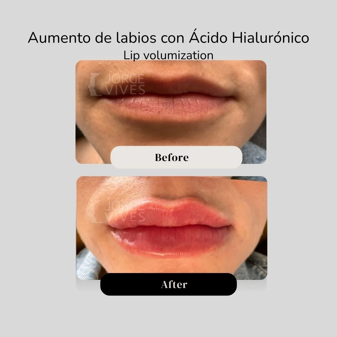 Lip volumization with hyaluronic acid filler before and after - Dr. Jorge Vives - Cartagena, Colombia 8