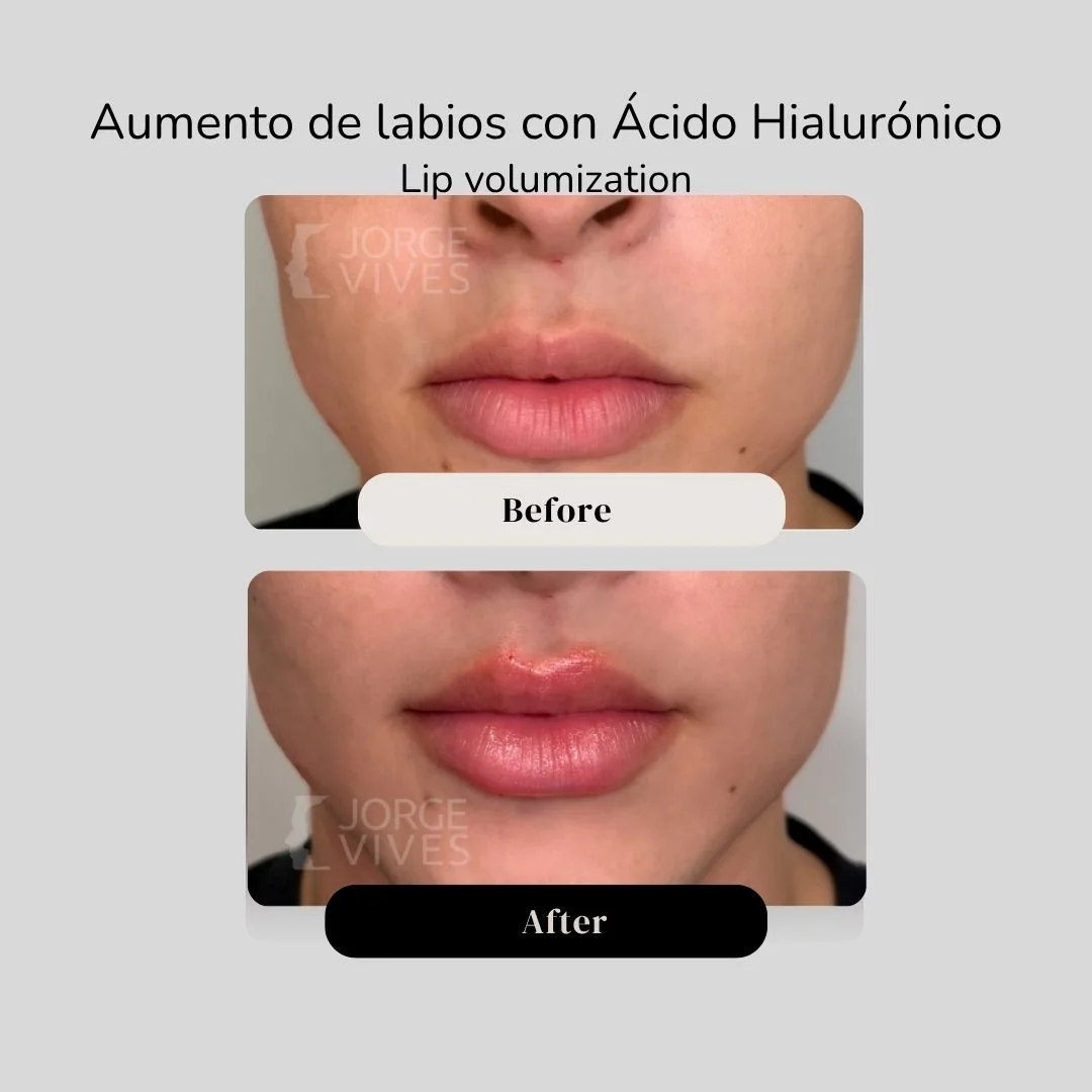 Lip volumization with hyaluronic acid filler before and after - Dr. Jorge Vives - Cartagena, Colombia 9