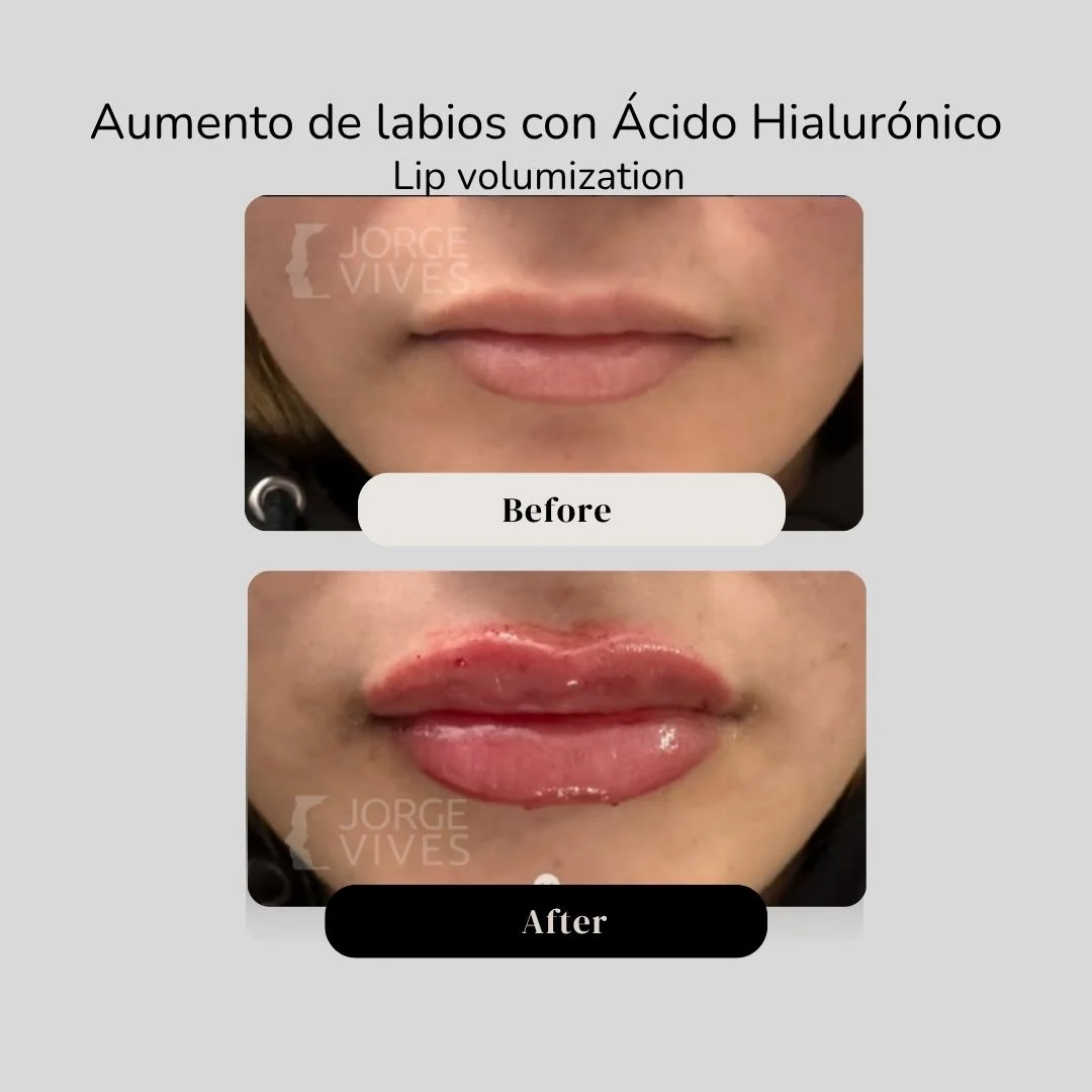 Lip volumization with hyaluronic acid filler before and after - Dr. Jorge Vives - Cartagena, Colombia