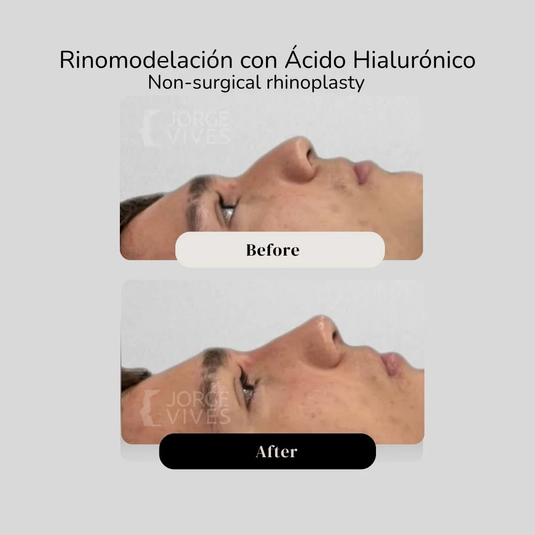 Non surgical rhinoplasty with hyaluronic acid filler - Dr. Jorge Vives - Cartagena, Colombia 1