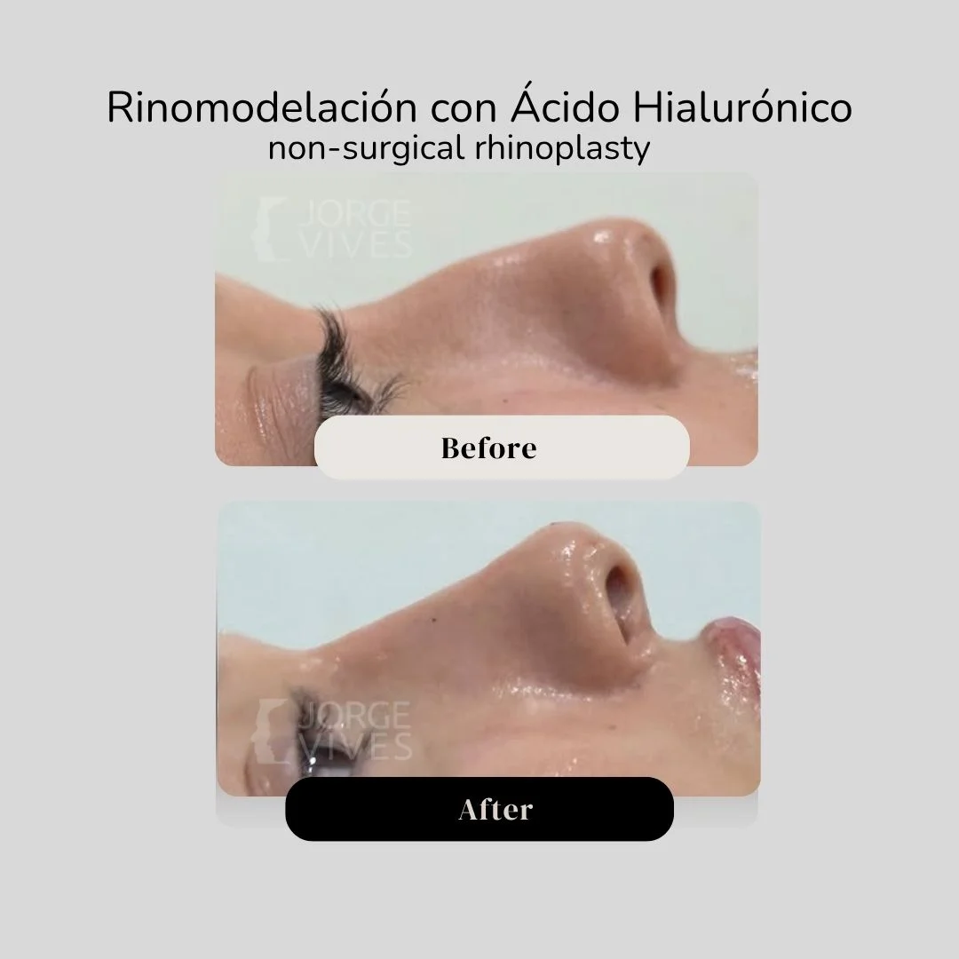 Non surgical rhinoplasty with hyaluronic acid filler - Dr. Jorge Vives - Cartagena, Colombia 2