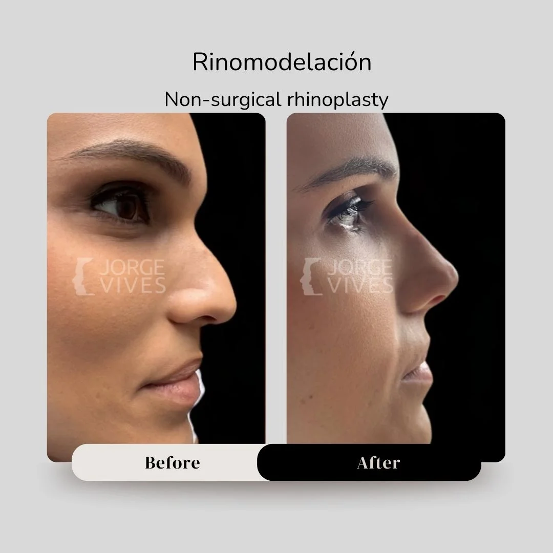 Non surgical rhinoplasty with hyaluronic acid filler - Dr. Jorge Vives - Cartagena, Colombia 3