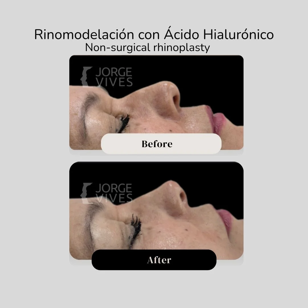 Non surgical rhinoplasty with hyaluronic acid filler - Dr. Jorge Vives - Cartagena, Colombia 4