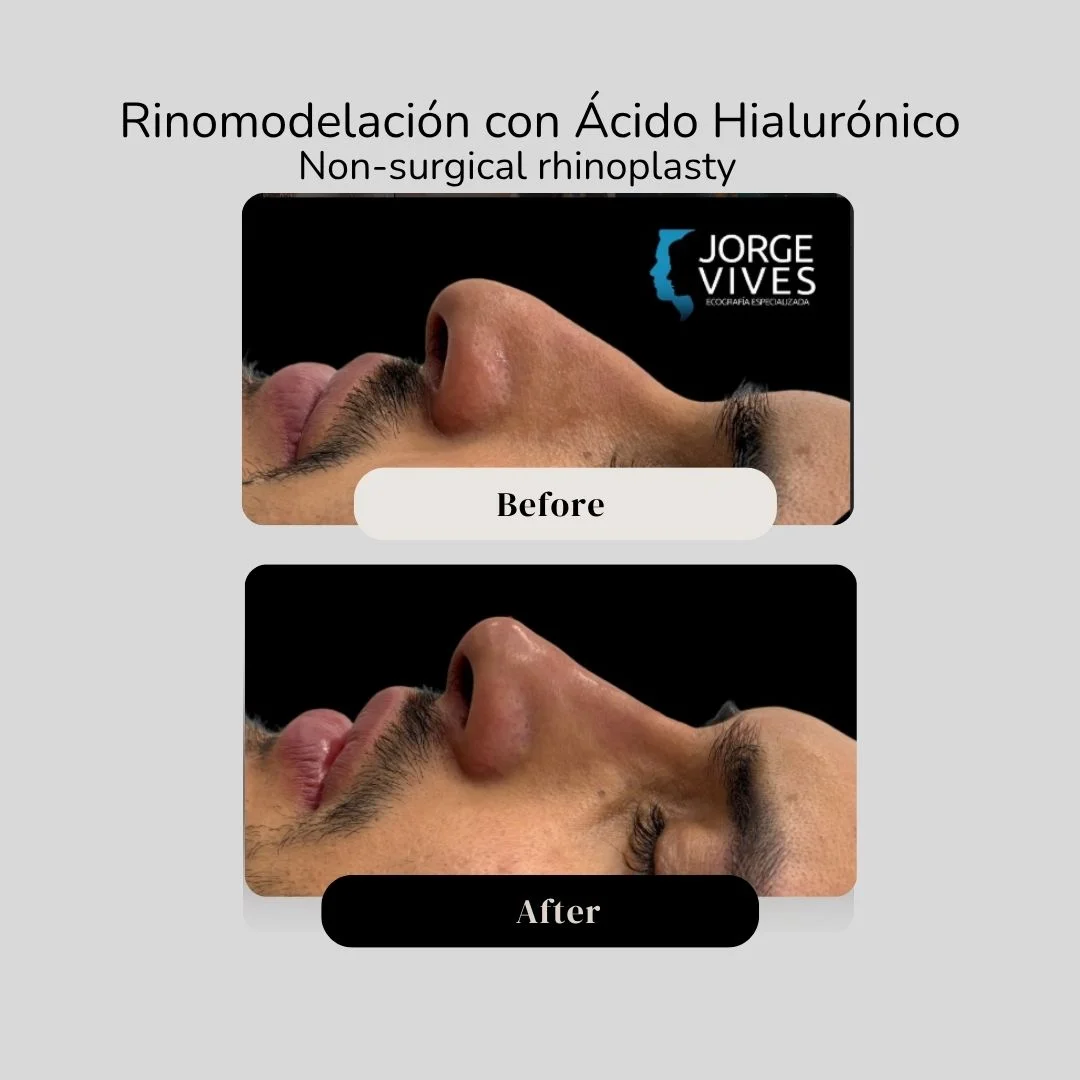 Non surgical rhinoplasty with hyaluronic acid filler - Dr. Jorge Vives - Cartagena, Colombia 5
