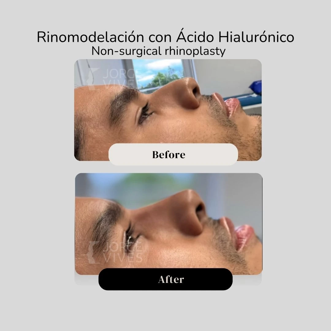 Non surgical rhinoplasty with hyaluronic acid filler - Dr. Jorge Vives - Cartagena, Colombia 6