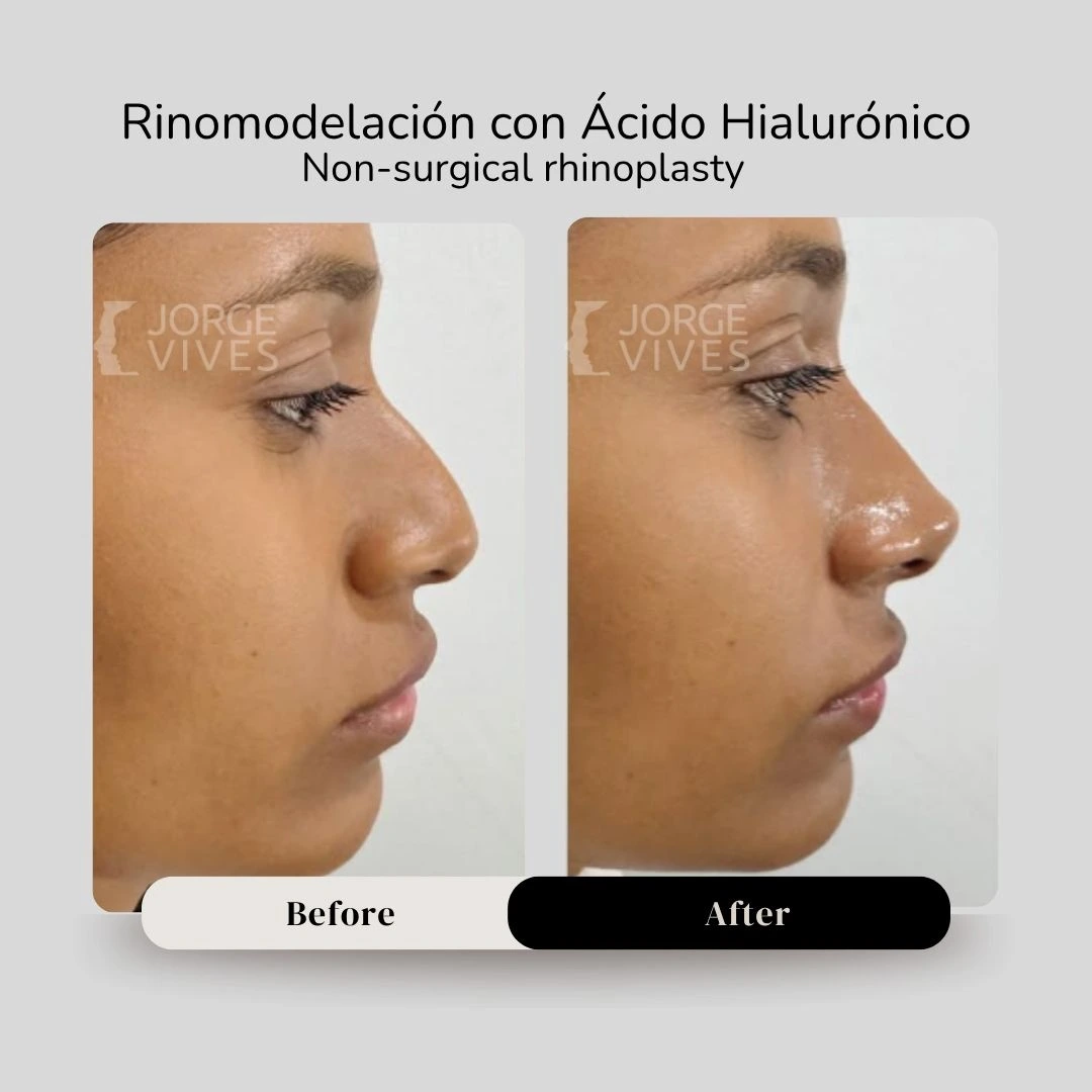Non surgical rhinoplasty with hyaluronic acid filler - Dr. Jorge Vives - Cartagena, Colombia 7