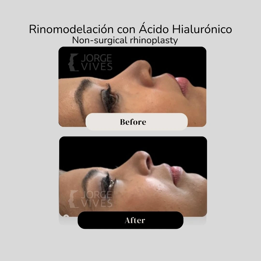 Non surgical rhinoplasty with hyaluronic acid filler before and after - Dr. Jorge Vives - Cartagena, Colombia 8