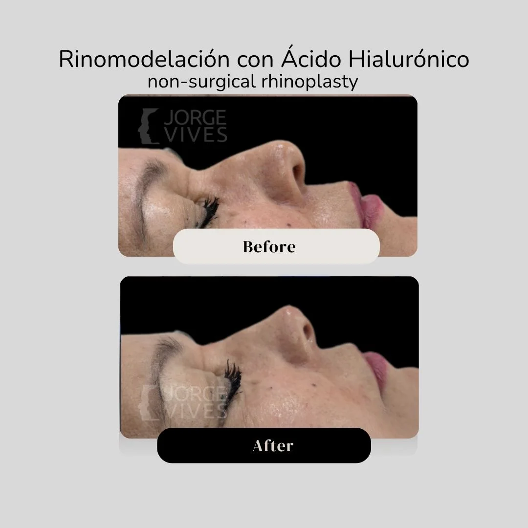 Non surgical rhinoplasty with hyaluronic acid filler - Dr. Jorge Vives - Cartagena, Colombia