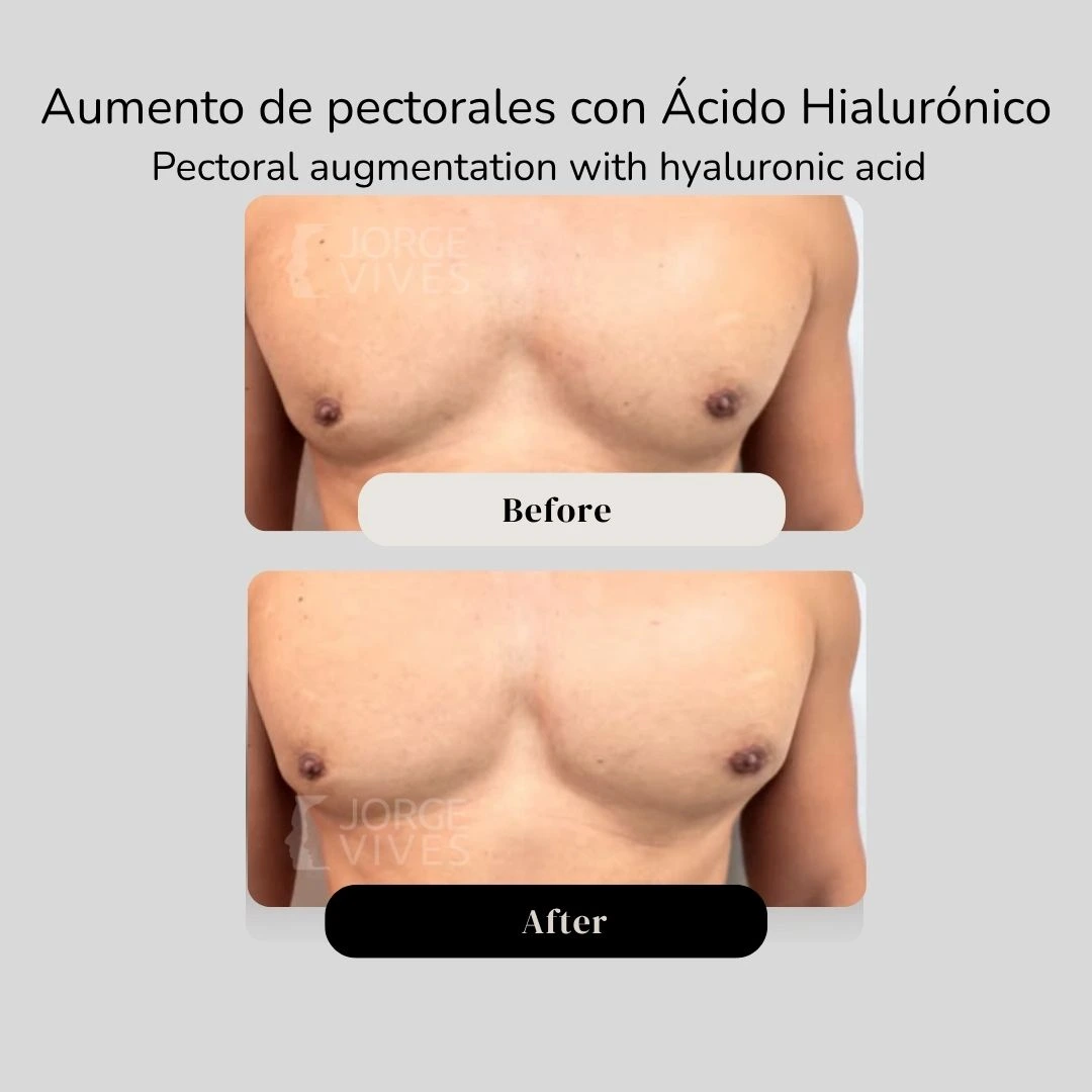 Pectoral augmentation with hyaluronic acid before and after - Dr. Jorge Vives - Cartagena, Colombia