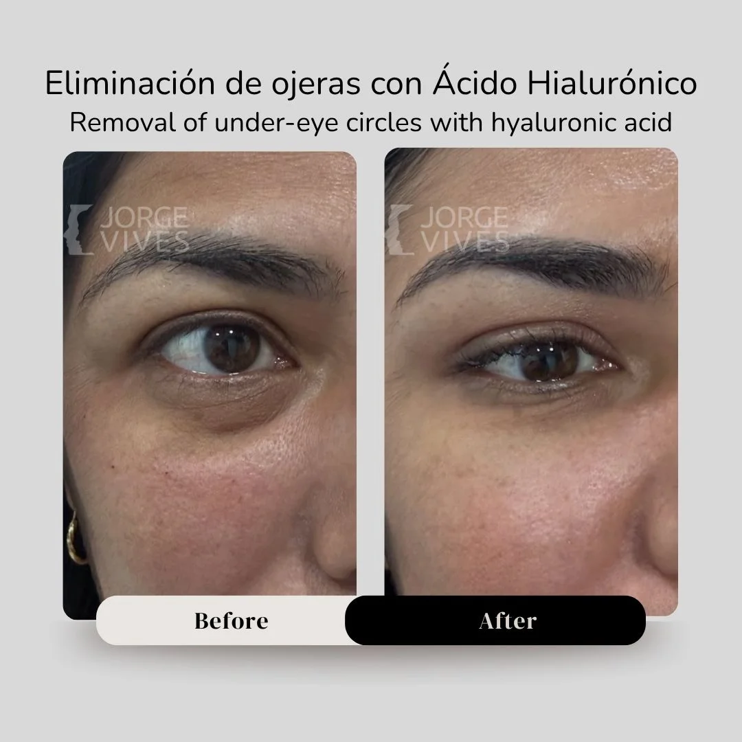 Removal of undereye circles with hyaluronic acid before and after - Dr. Jorge Vives - Cartagena, Colombia 1