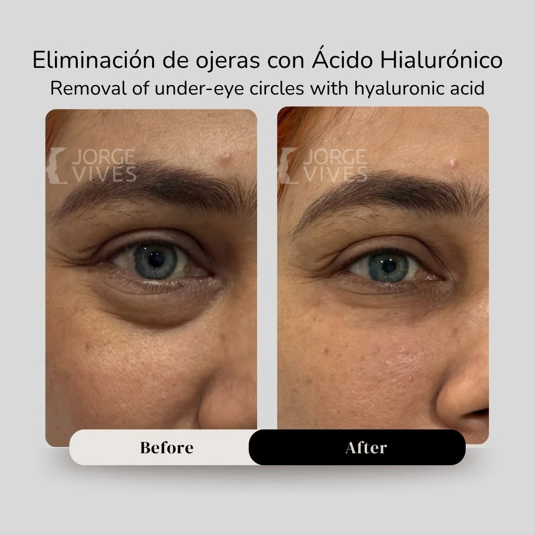 Removal of undereye circles with hyaluronic acid before and after - Dr. Jorge Vives - Cartagena, Colombia