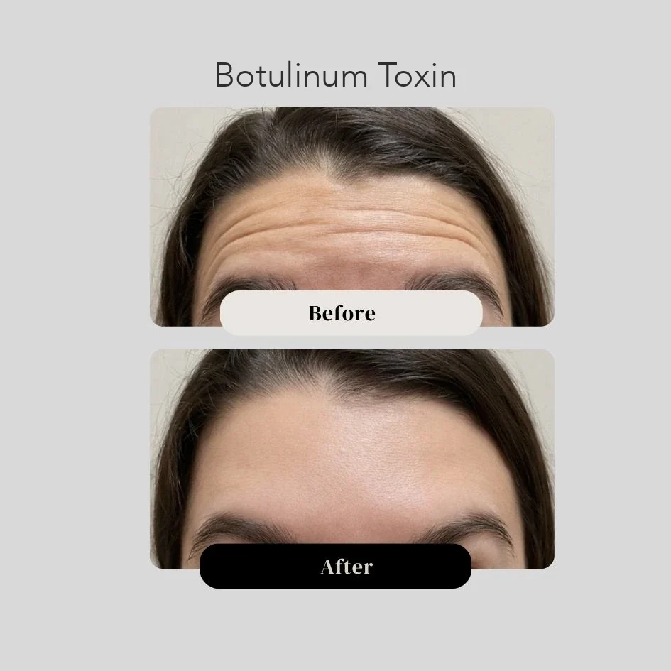 Botox on the forehead, before and after, Cartagena, Colombia