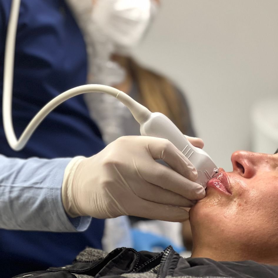 Ultrasound assessment of migrated lip filler before hyaluronidase treatment, Dr. Jorge Vives, Colombia