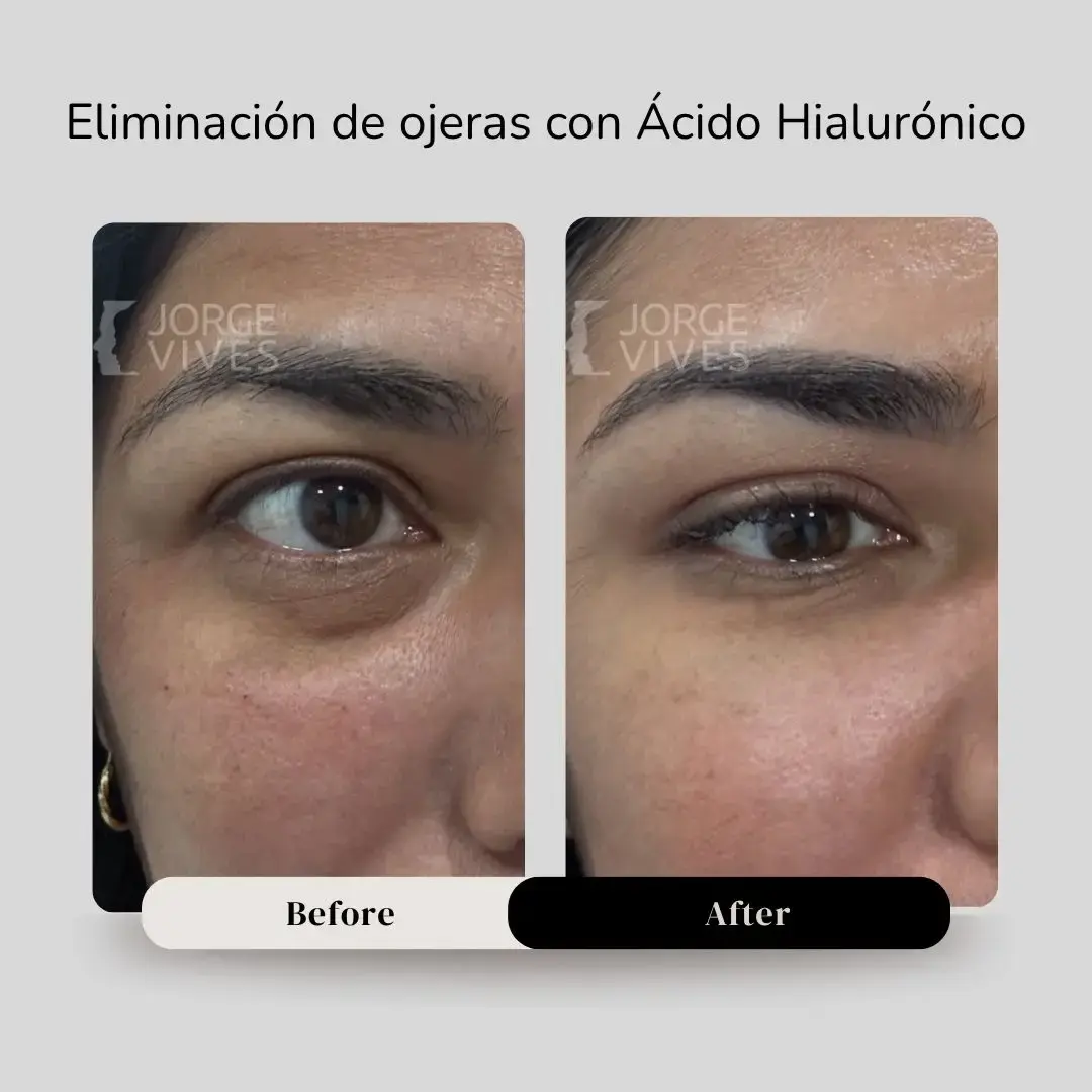Ácido Hialuronico para Ojeras antes y después- Dr. Jorge Vives Cartagena
