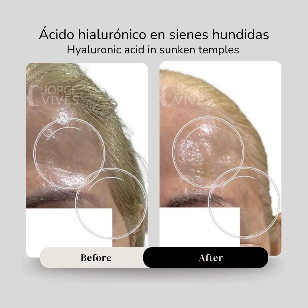 Ácido hialurónico para sienes antes y después - Dr. Jorge Vives - Cartagena, Colombia - 080926