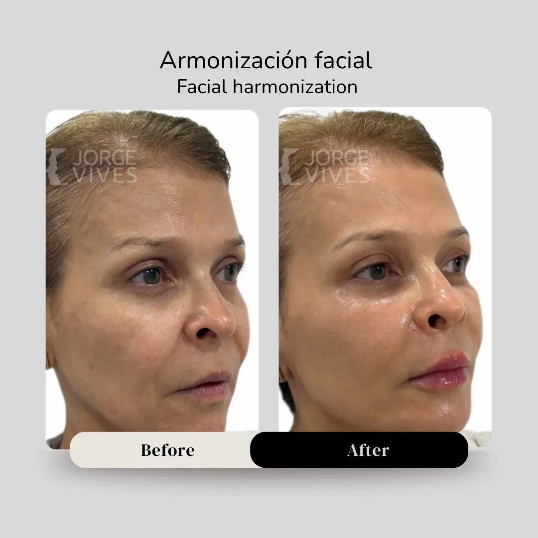 Armonización facial antes y después - Dr. Jorge Vives - Cartagena, Colombia - 080926 1