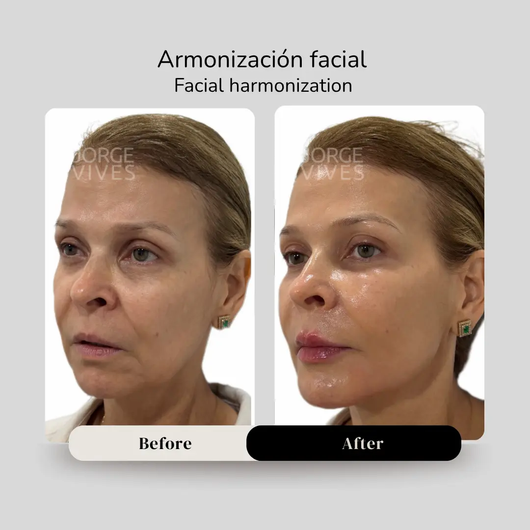 Armonización facial antes y después - Dr. Jorge Vives - Cartagena, Colombia - 080926 2