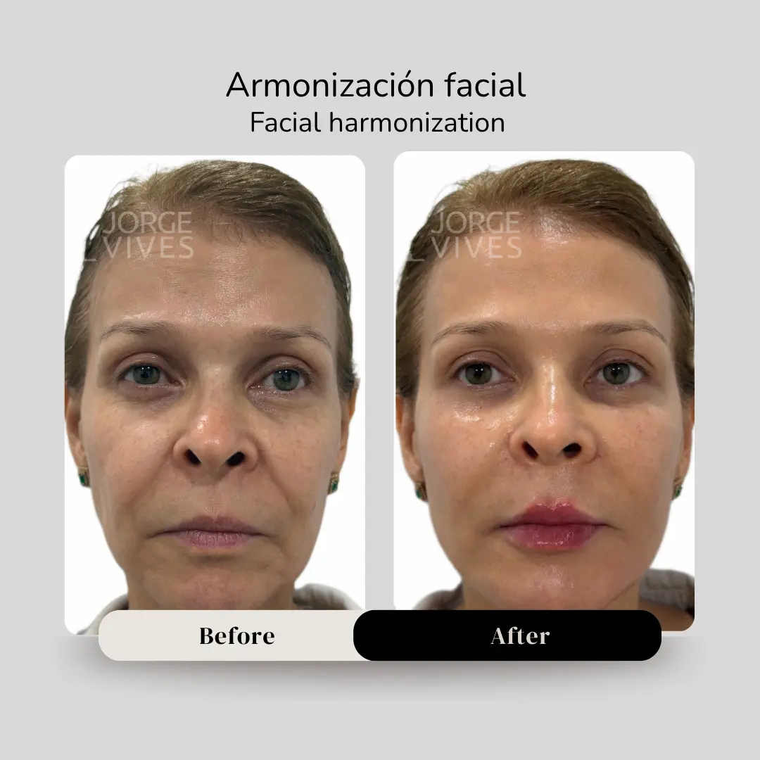 Armonización facial antes y después - Dr. Jorge Vives - Cartagena, Colombia - 080926