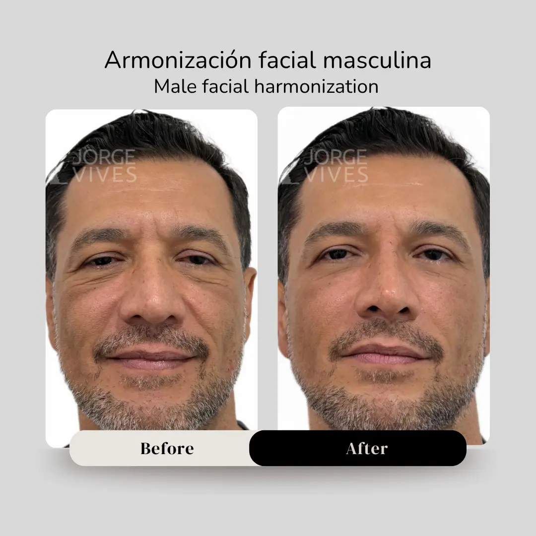 Armonización facial masculina antes y después - Dr. Jorge Vives - Cartagena, Colombia - 080926 1