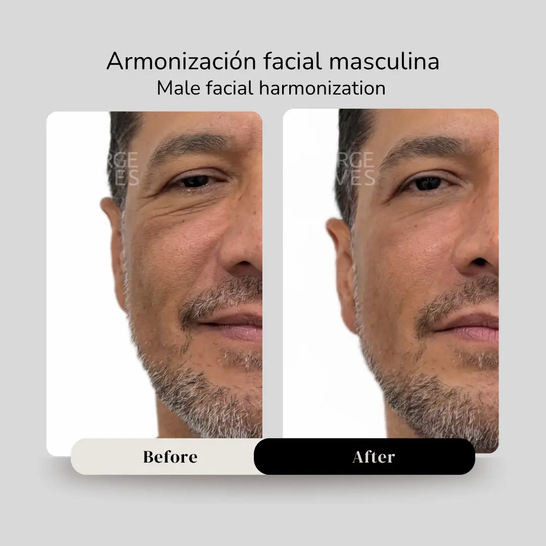 Armonización facial masculina antes y después - Dr. Jorge Vives - Cartagena, Colombia - 080926