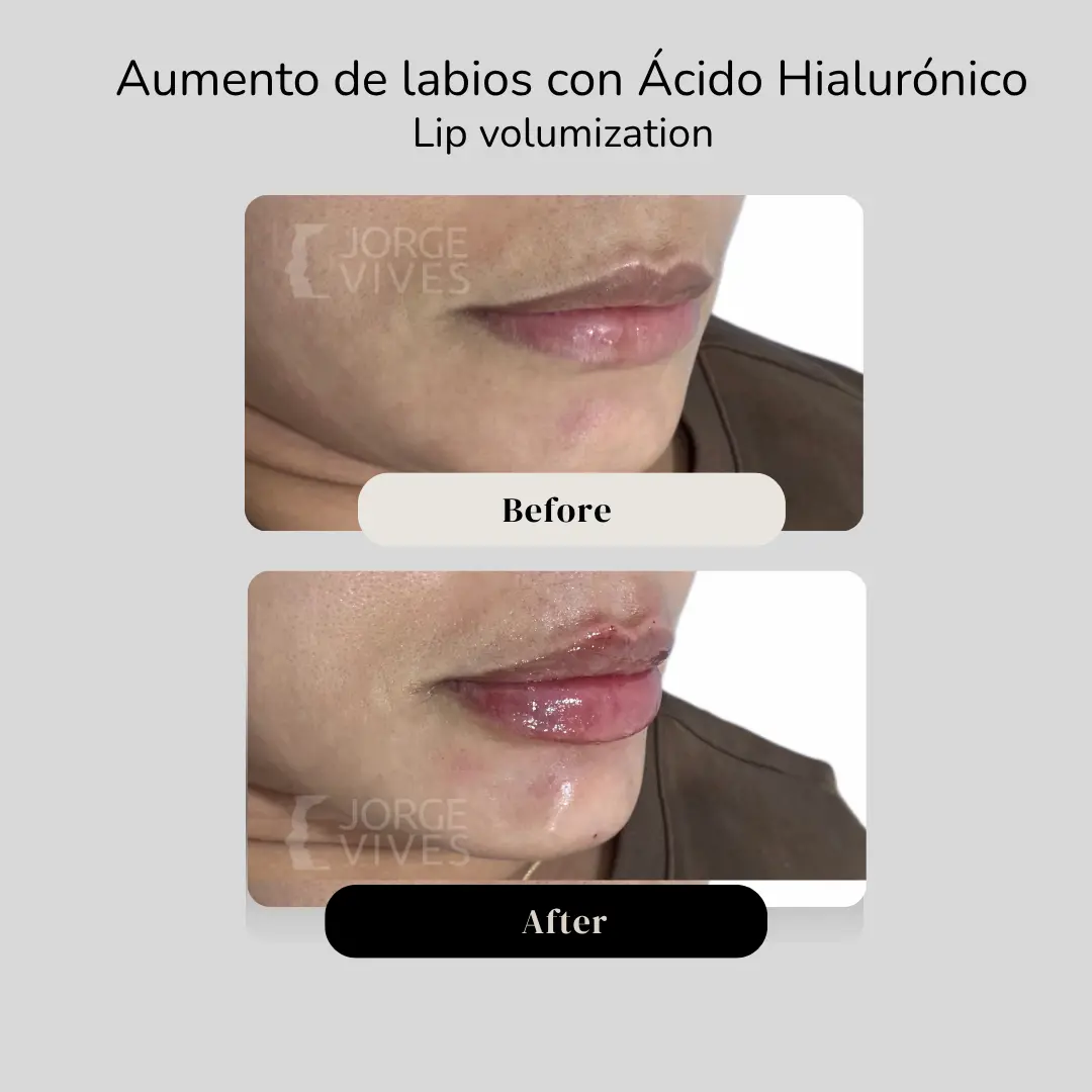 Aumento de labios con ácido hialurónico para sienes antes y después - Dr. Jorge Vives - Cartagena, Colombia - 080926 1