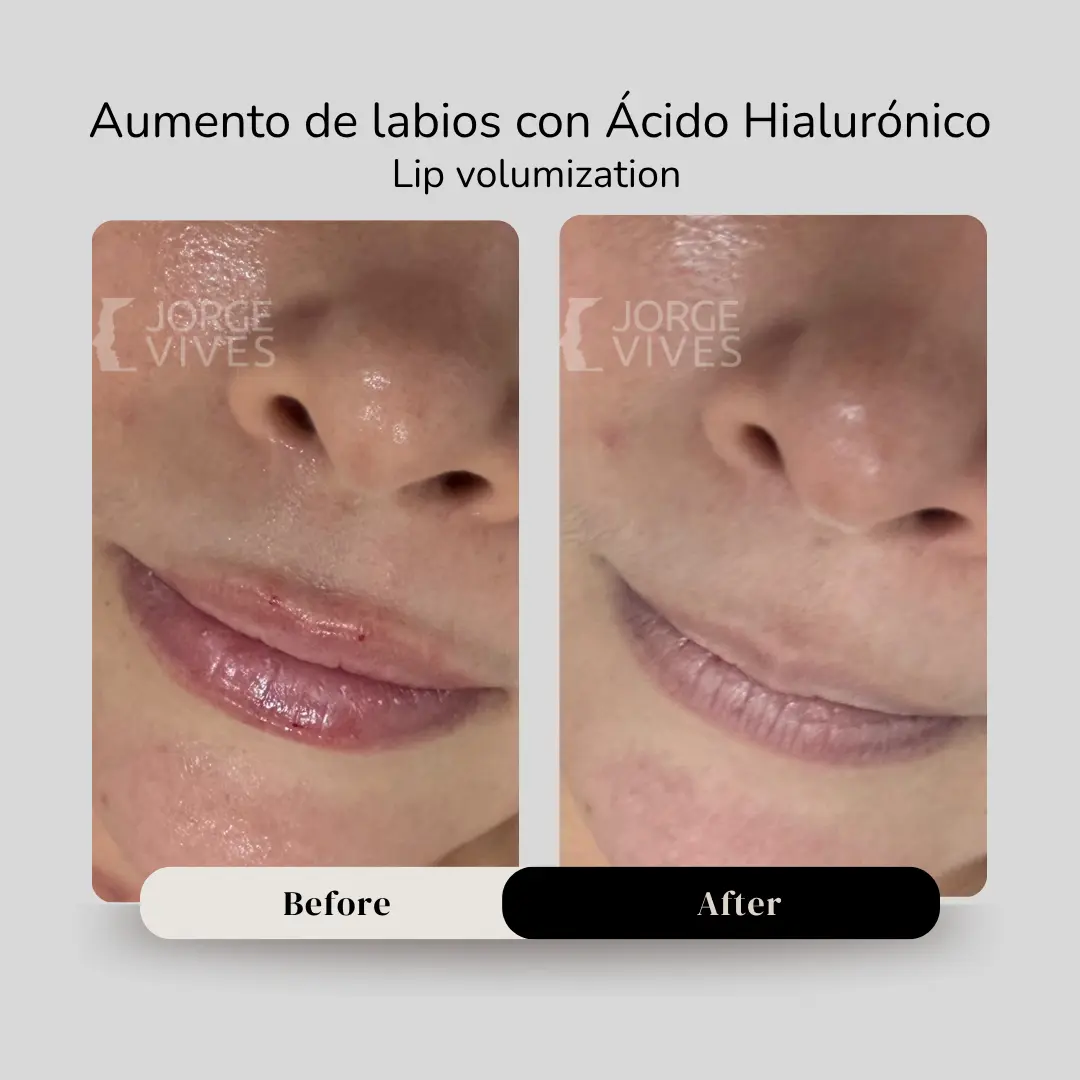 Aumento de labios con ácido hialurónico para sienes antes y después - Dr. Jorge Vives - Cartagena, Colombia - 080926