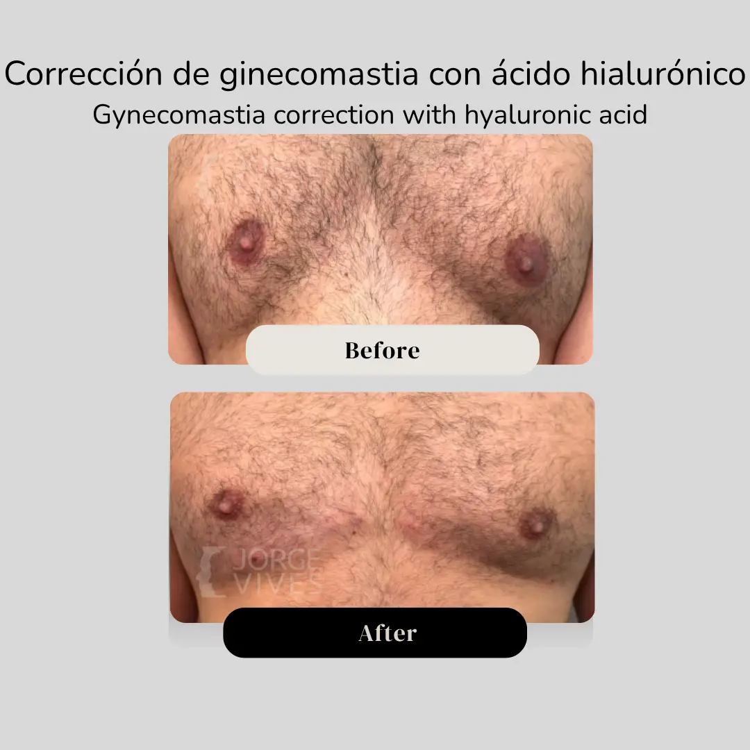 Corrección de ginecomastia con ácido hialurónico antes y después - Dr. Jorge Vives - Cartagena, Colombia - 080926