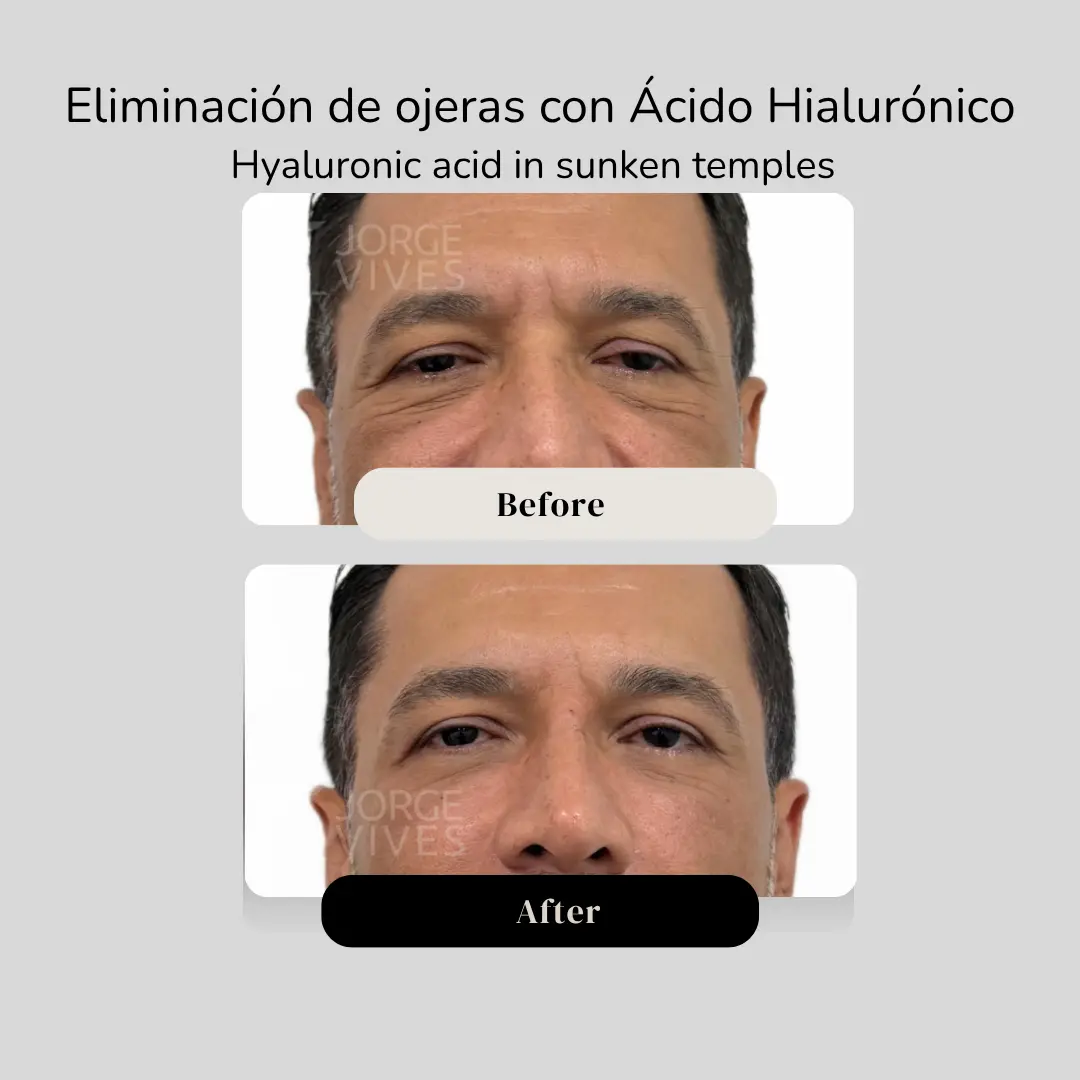 Eliminación de ojeras con ácido hialurónico para sienes antes y después - Dr. Jorge Vives - Cartagena, Colombia - 080926 1