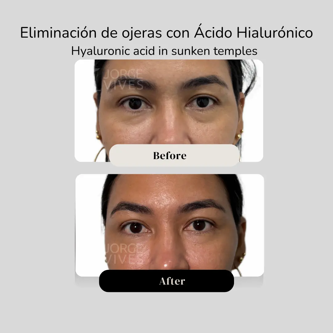 Eliminación de ojeras con ácido hialurónico para sienes antes y después - Dr. Jorge Vives - Cartagena, Colombia - 080926 2
