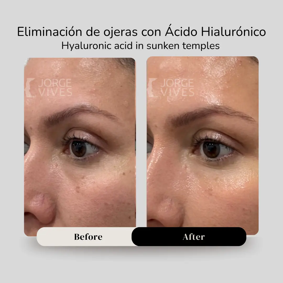 Eliminación de ojeras con ácido hialurónico para sienes antes y después - Dr. Jorge Vives - Cartagena, Colombia - 080926