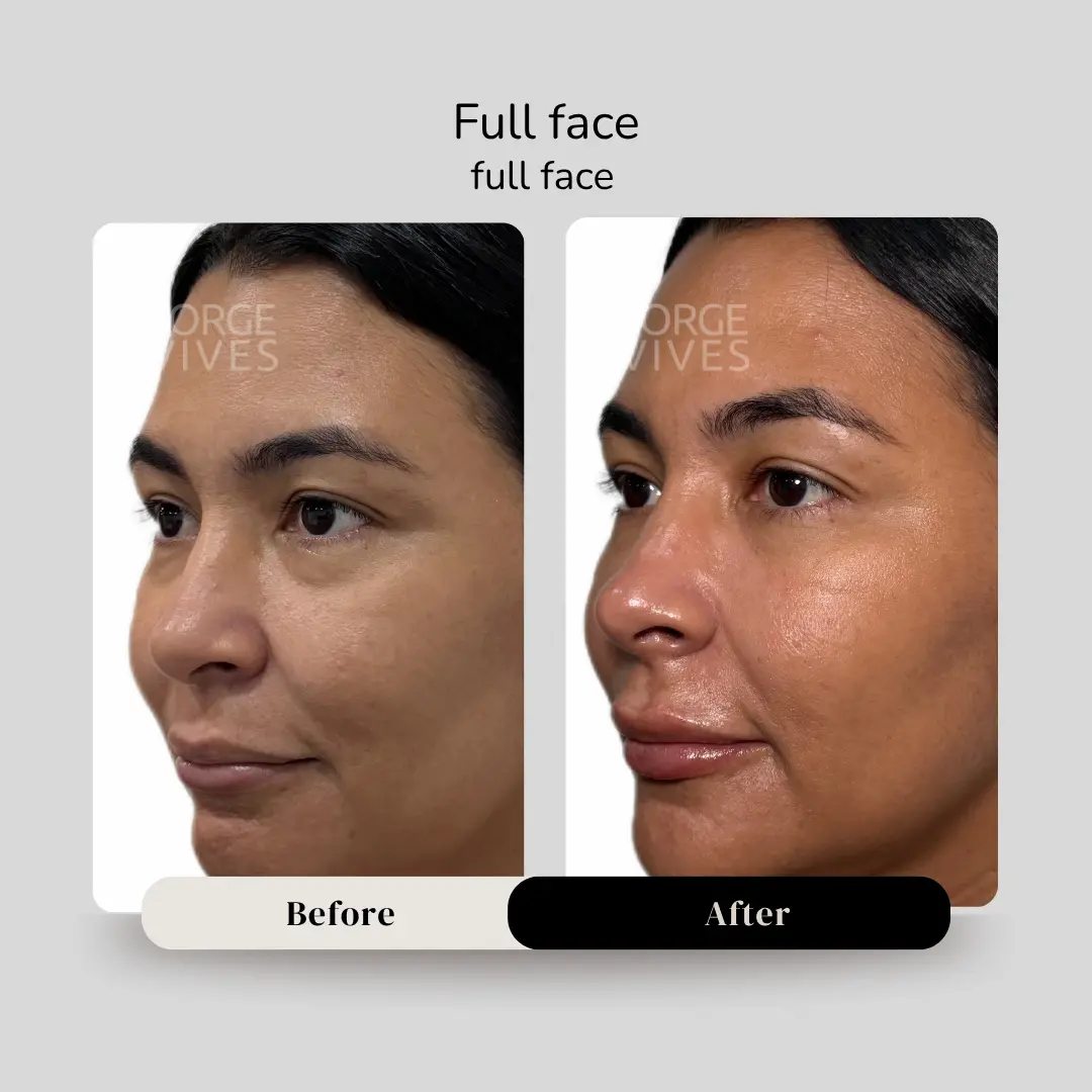 Full face antes y después - Dr. Jorge Vives - Cartagena, Colombia - 080926 1