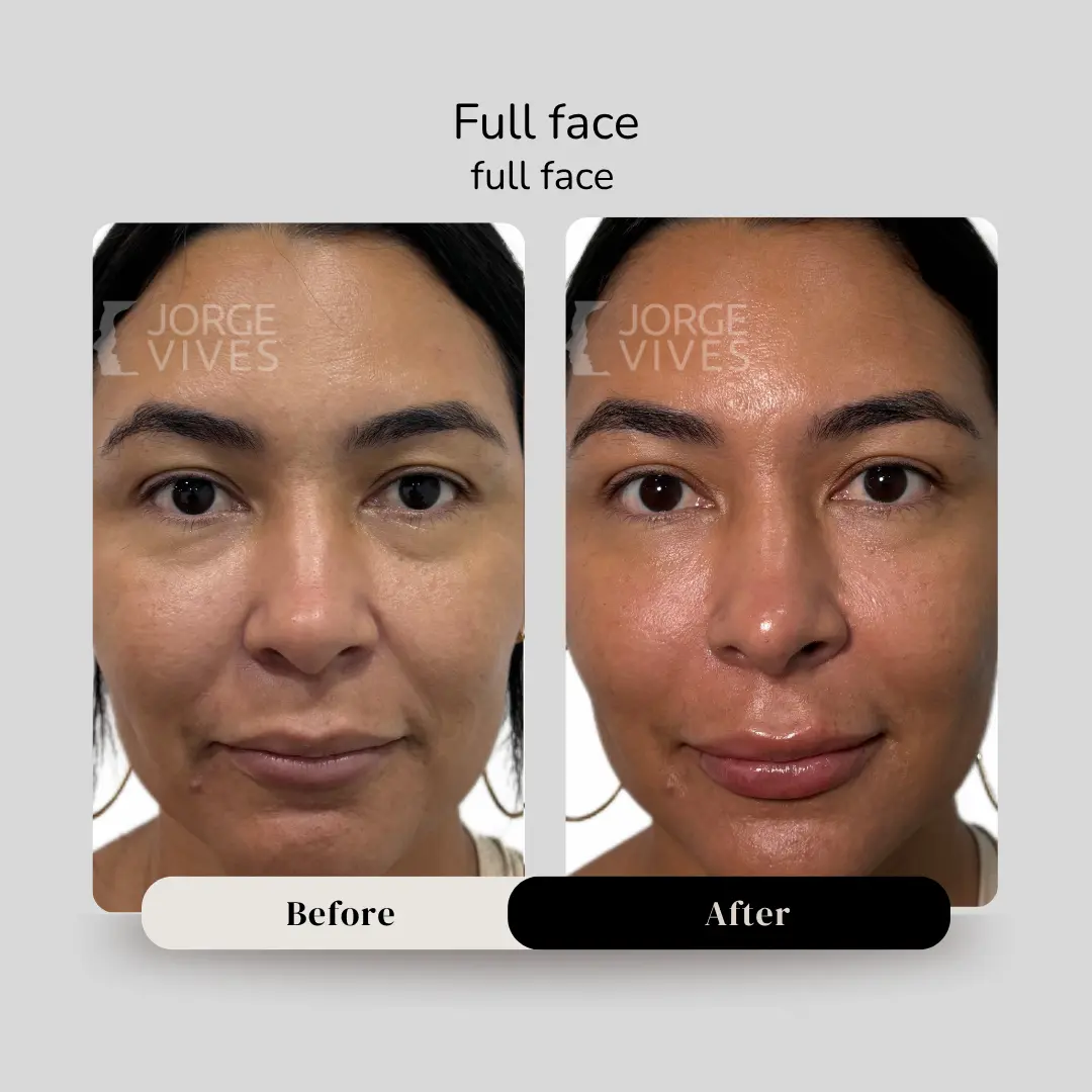 Full face antes y después - Dr. Jorge Vives - Cartagena, Colombia - 080926