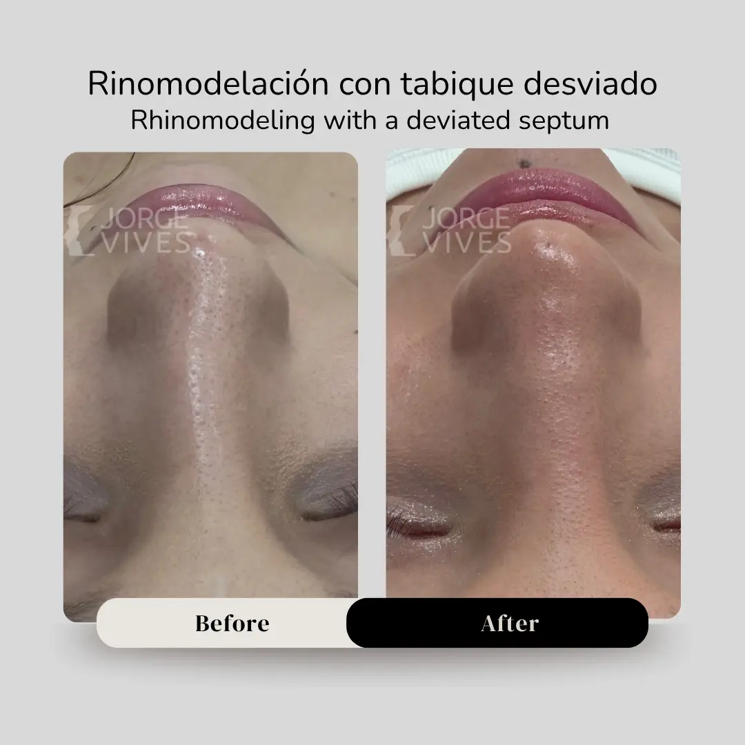 Rinomodelación con tabique desviado antes y después - Dr. Jorge Vives - Cartagena, Colombia - 080926