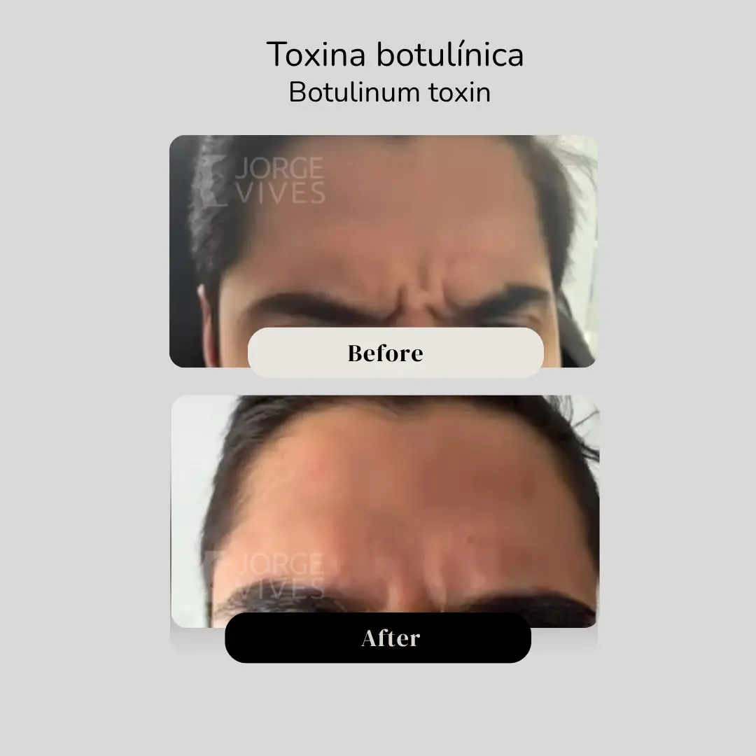 Toxina botulínica en entrecejo antes y después - hombre - Dr. Jorge Vives - Cartagena, Colombia - 080926