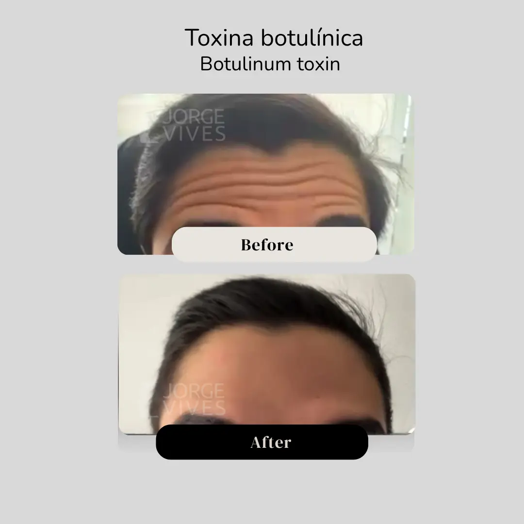 Toxina botulínica en frente antes y después - hombre - Dr. Jorge Vives - Cartagena, Colombia - 080926